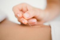 Das Setzen einer Akupunktur-Nadel am Bauch einer Frau.